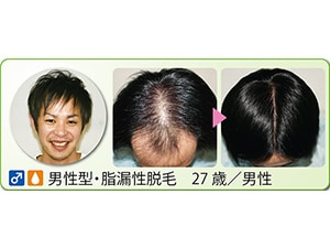 毛髪クリニック リーブ21 - HITOWAグループ福利厚生プログラム